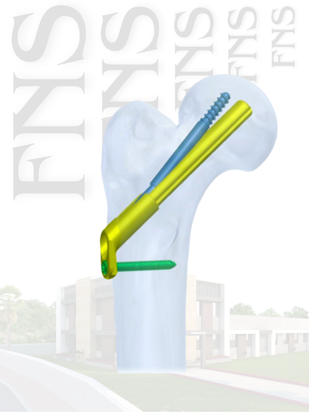 Femoral Neck System implant and specification presentation